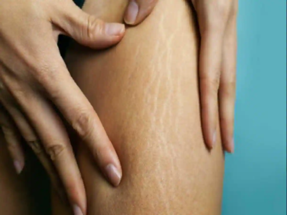 Stretch Marks: क्या आप स्ट्रेच मार्क्स से हैं परेशान, तो फॉलो करें ये नेचुरल टिप्स