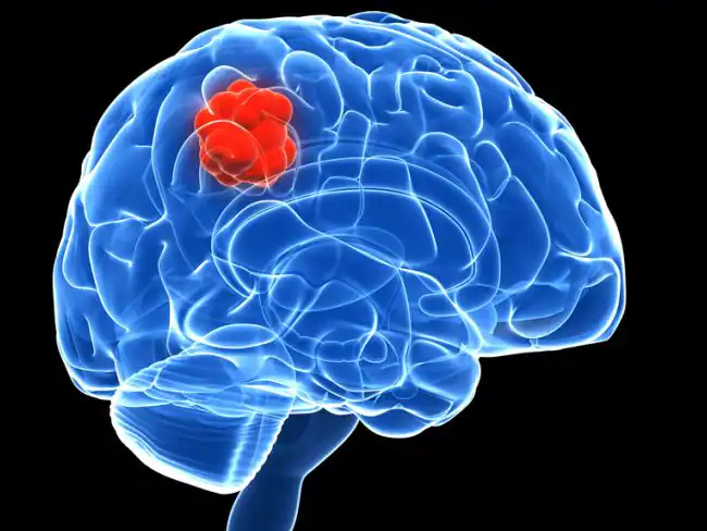 Brain Tumor को न लें हल्के में, जानिए शुरुआती लक्षण से लेकर इलाज तक सबकुछ