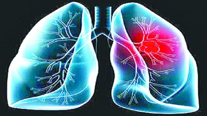 Pollution : धूम्रपान न करे बिना भी फूल रहा फेफड़ों का दम, प्रदूषण है इसके लिए जिम्मेदार