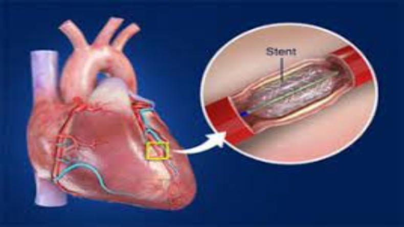 Shreyas Talpade Heart Attack: एंजियोप्लास्टी क्या है? जानें इसके उपचार