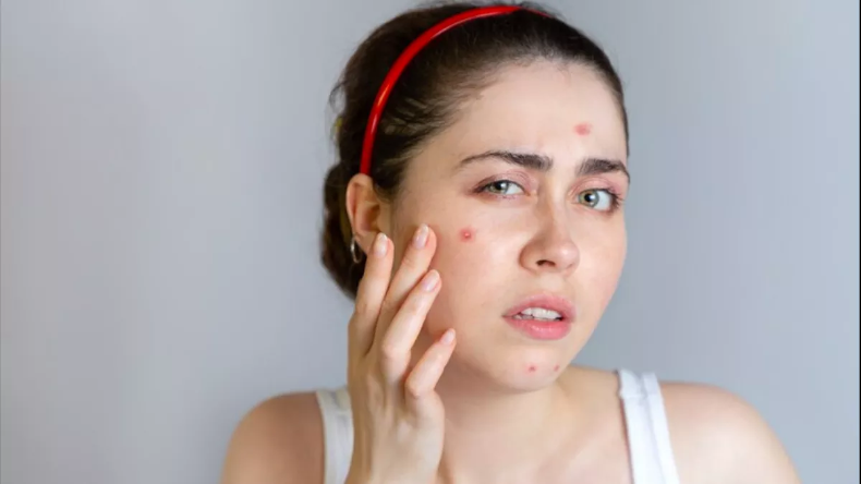 Pimple Home remedies: पिंपल के दागों से निजात पाने के लिए करें ये उपाए