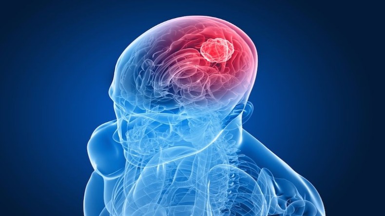 World Brain Tumor Day 2024: किन लोगों को होता है ब्रेन ट्यूमर, जानें इसका शुरुआती लक्षण और कारण