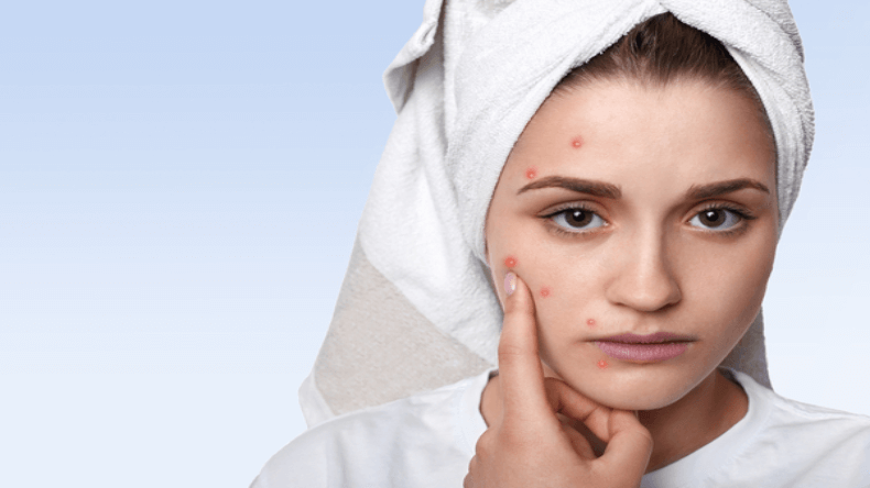 Beauty Tips: कील और मुंहासे से परेशान हैं तो फॉलो करें ये टिप्स, मिलेगी  क्लियर स्किन