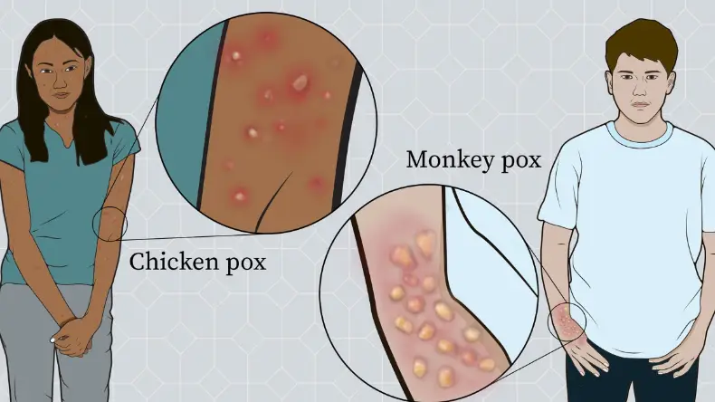 मंकीपॉक्स जैसी बीमारियों में ‘पॉक्स’ शब्द का इस्तेमाल, जानिए इसके पीछे की गहराई!